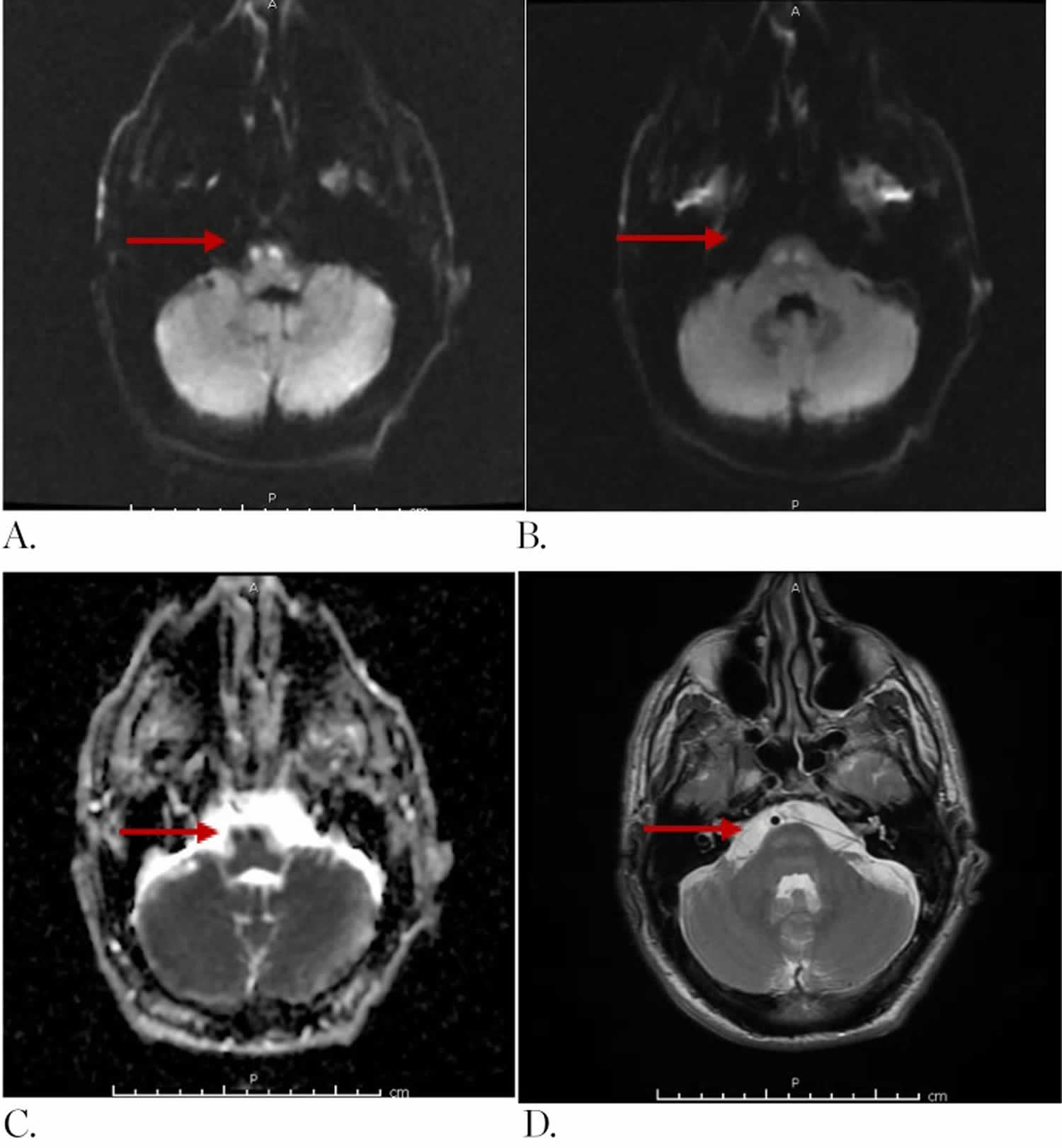 Locked-in Syndrome MRI