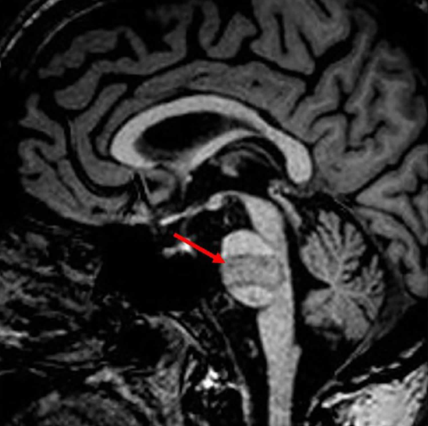 Locked-in syndrome MRI