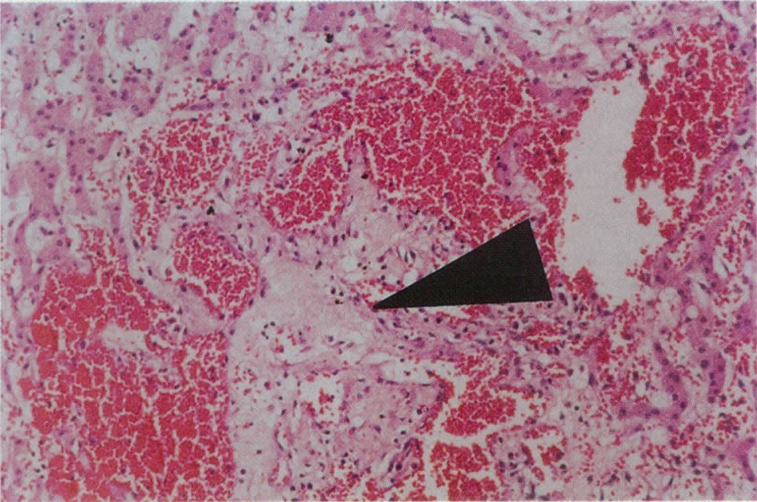 Peliosis hepatis liver biopsy specimen