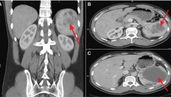 Spleen peliosis