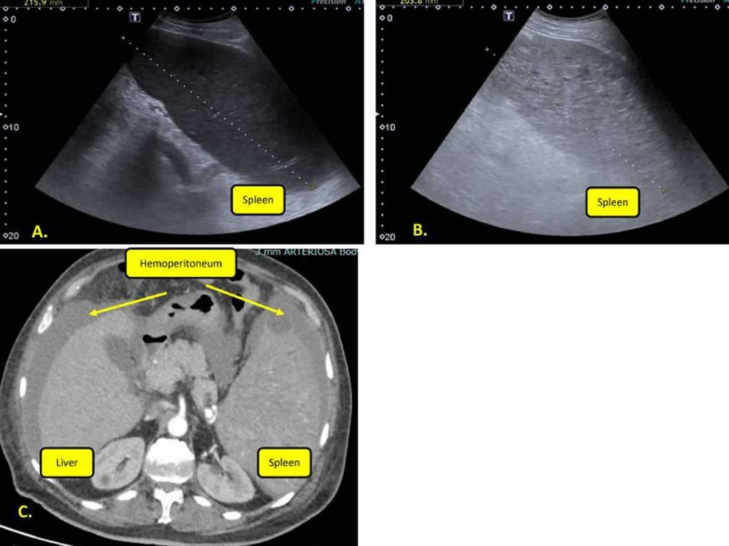 Spleen peliosis, causes, signs, symptoms, diagnosis & treatment