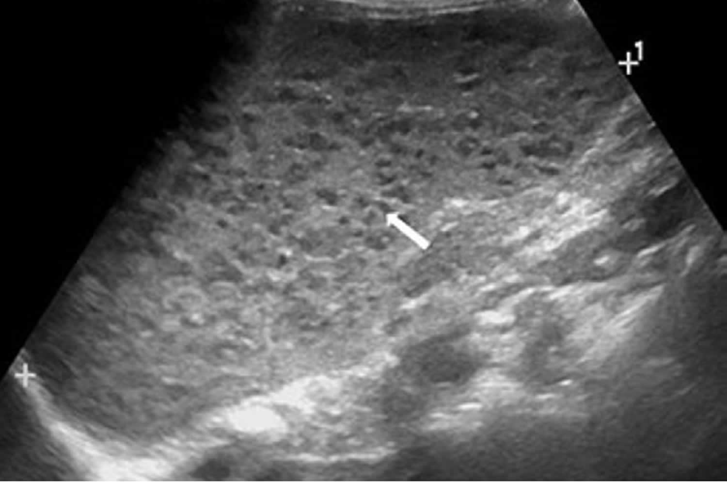 Spleen peliosis ultrasound