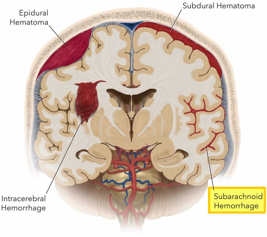 Subarachnoid Hemorrhage Causes Symptoms Diagnosis Treatment And Prognosis