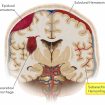 Subarachnoid hemorrhage