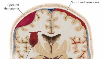 Subarachnoid hemorrhage