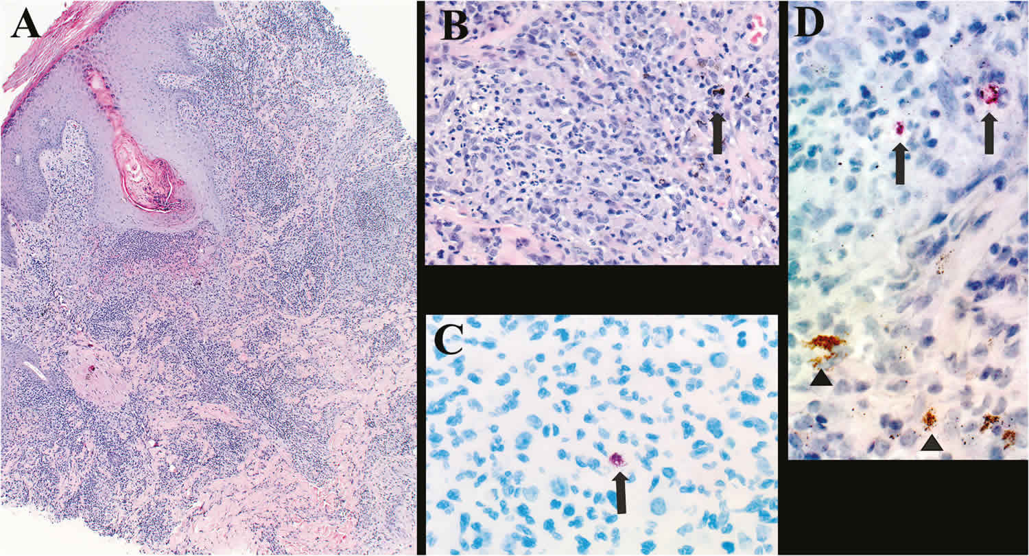 Atypical mycobacterial infection skin histopathology