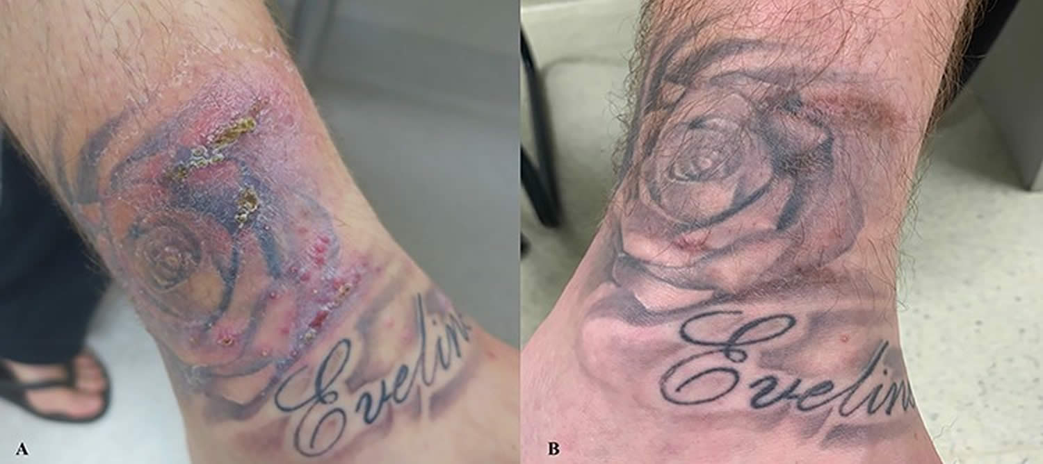 atypical mycobacterial infection after skin tattoo