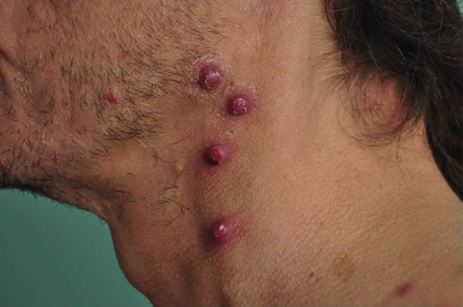 bacillary angiomatosis skin lesions