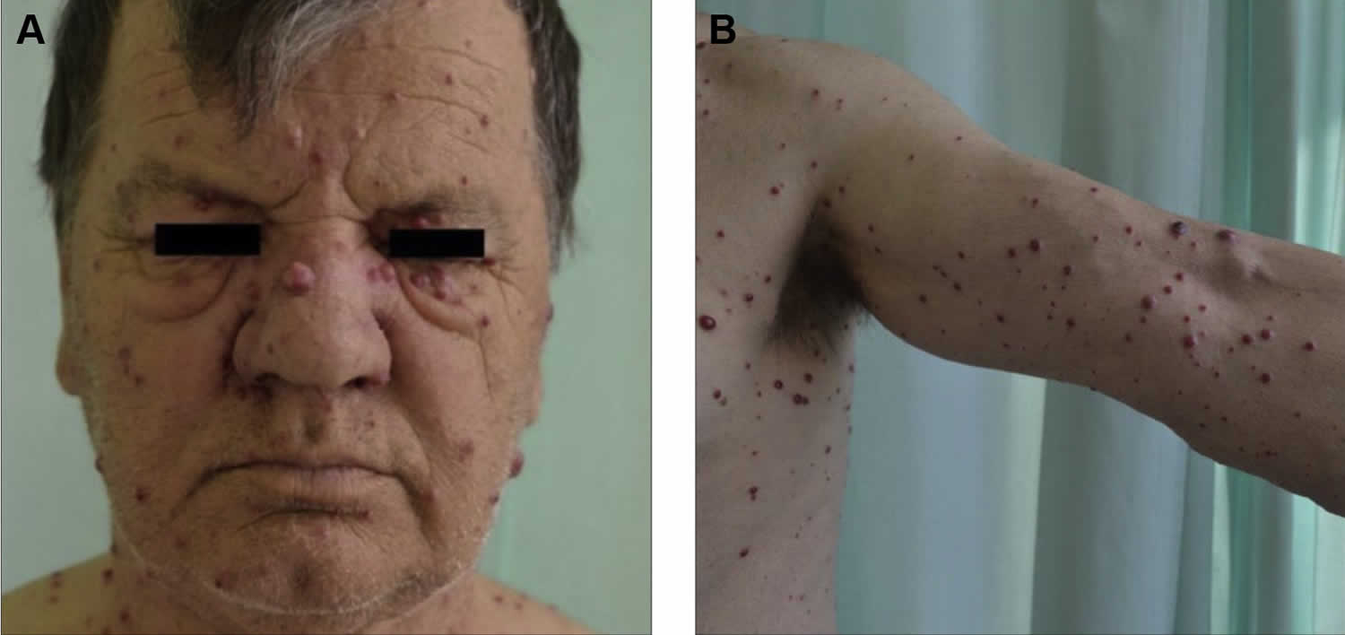 Bacillary angiomatosis skin lesions