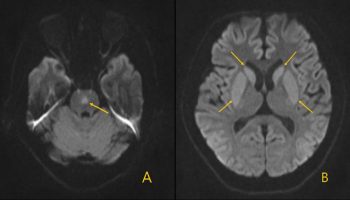 central pontine myelinolysis