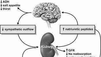 cerebral salt wasting