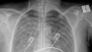 neurogenic pulmonary edema