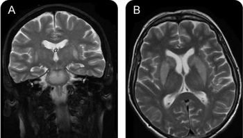 osmotic demyelination syndrome