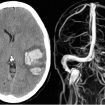 Cerebral venous thrombosis