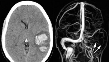 Cerebral venous thrombosis