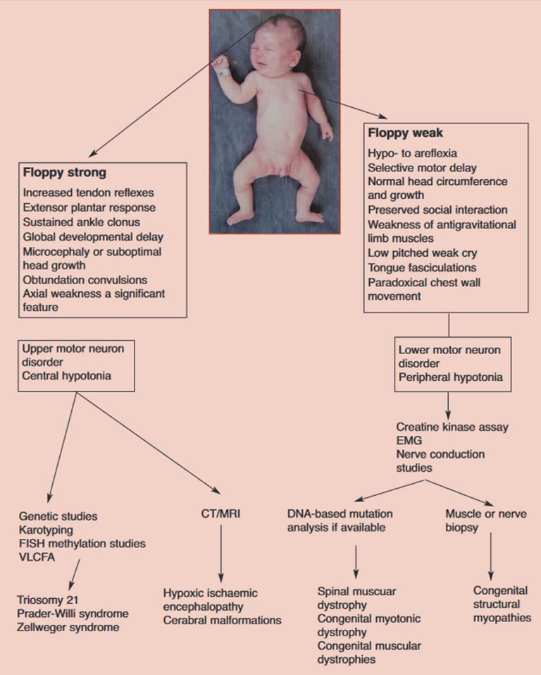 Floppy Infant Syndrome Causes, Symptoms, Diagnosis, Treatment & Prognosis