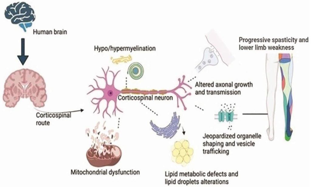 Hereditary spastic paraplegia, causes, symptoms, diagnosis, treatment ...