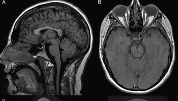 Idiopathic intracranial hypertension