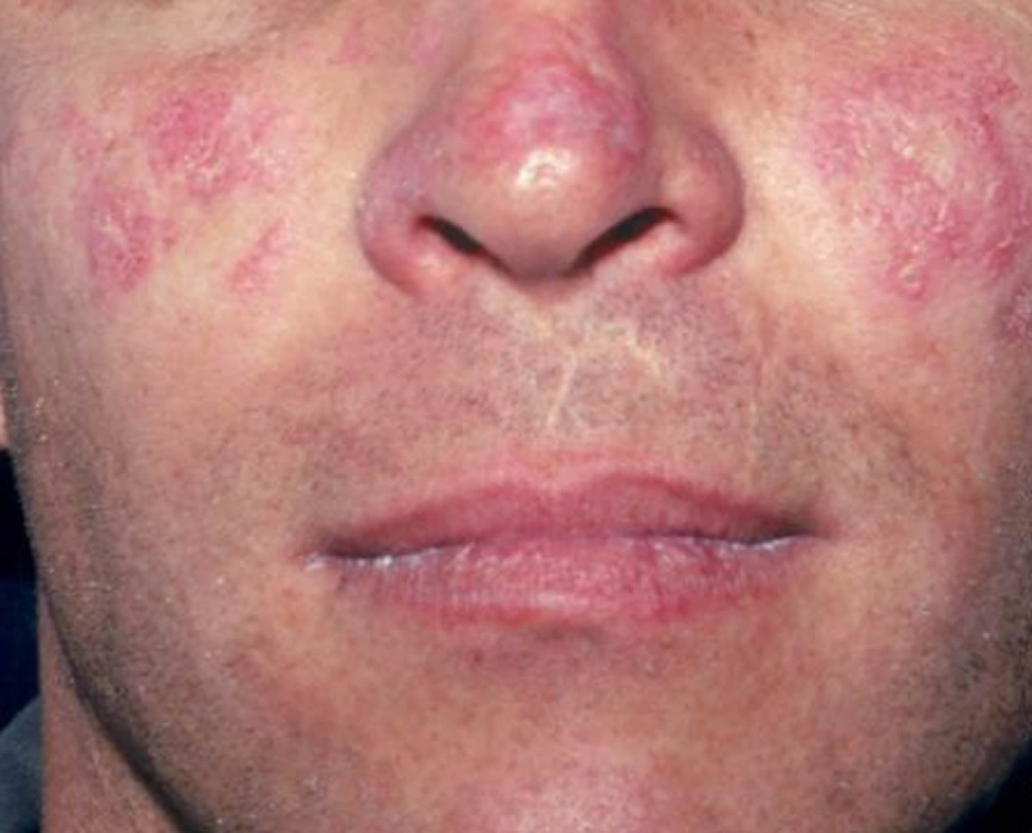 systemic lupus erythematosus butterfly rash