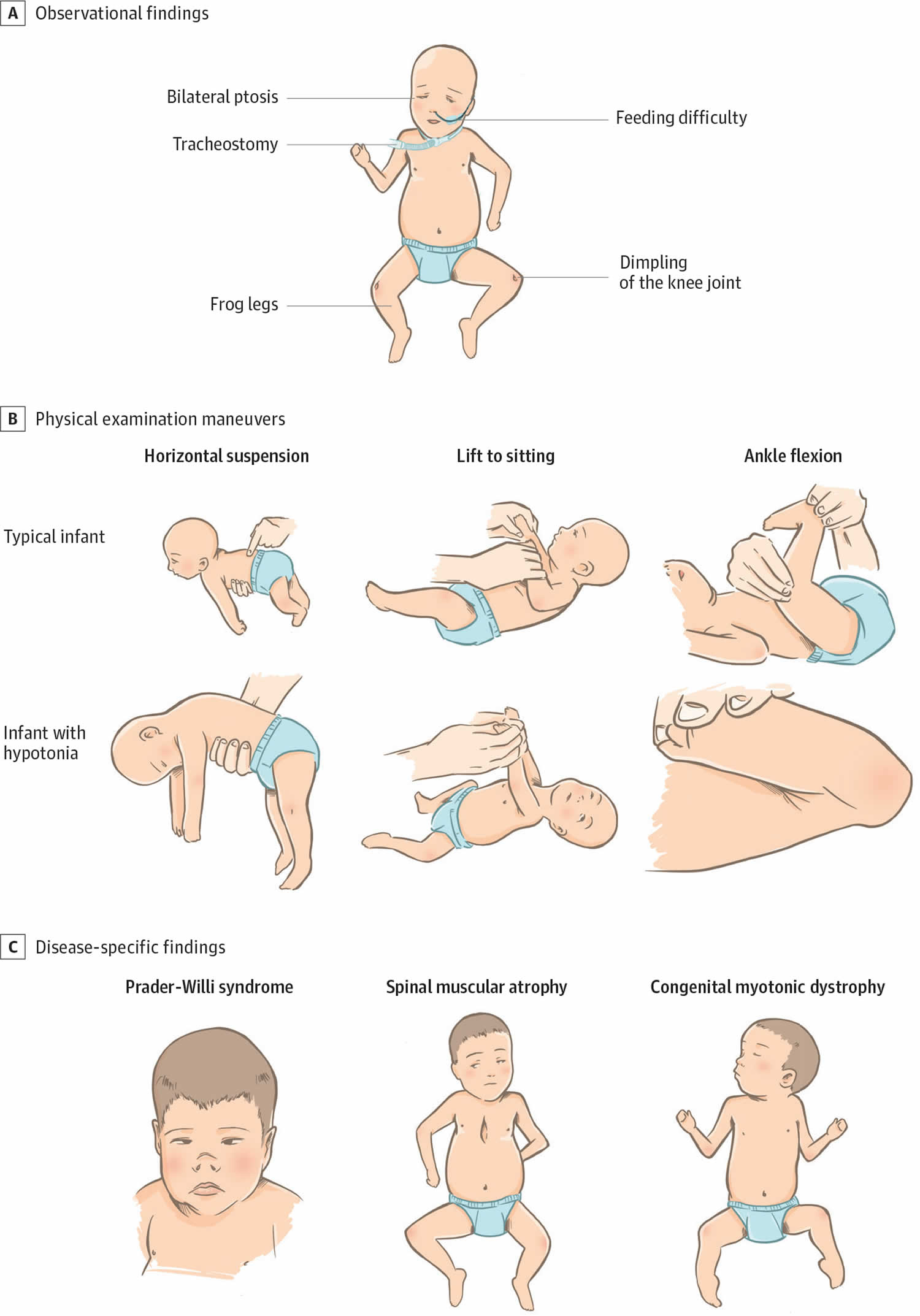 Physical examination findings in floppy infant syndrome
