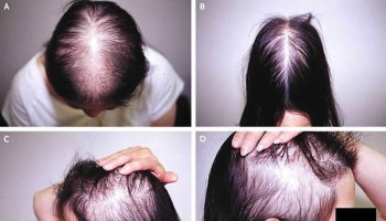 hair loss in women