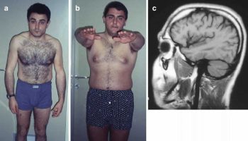 hereditary spastic paraplegia