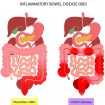 inflammatory bowel disease