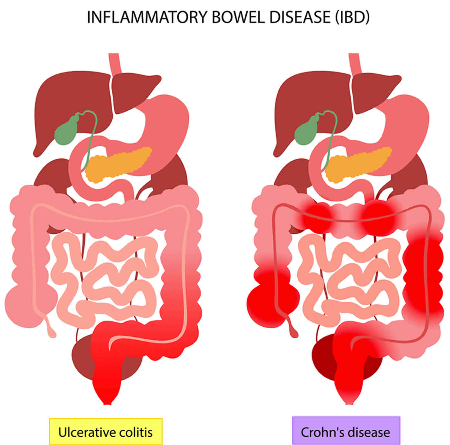 Inflammatory Bowel Disease Causes Signs Symptoms Diagnosis Treatment