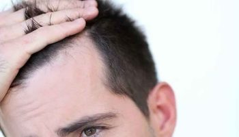 male pattern baldness