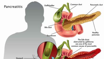 pancreatitis