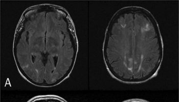 posterior reversible encephalopathy syndrome