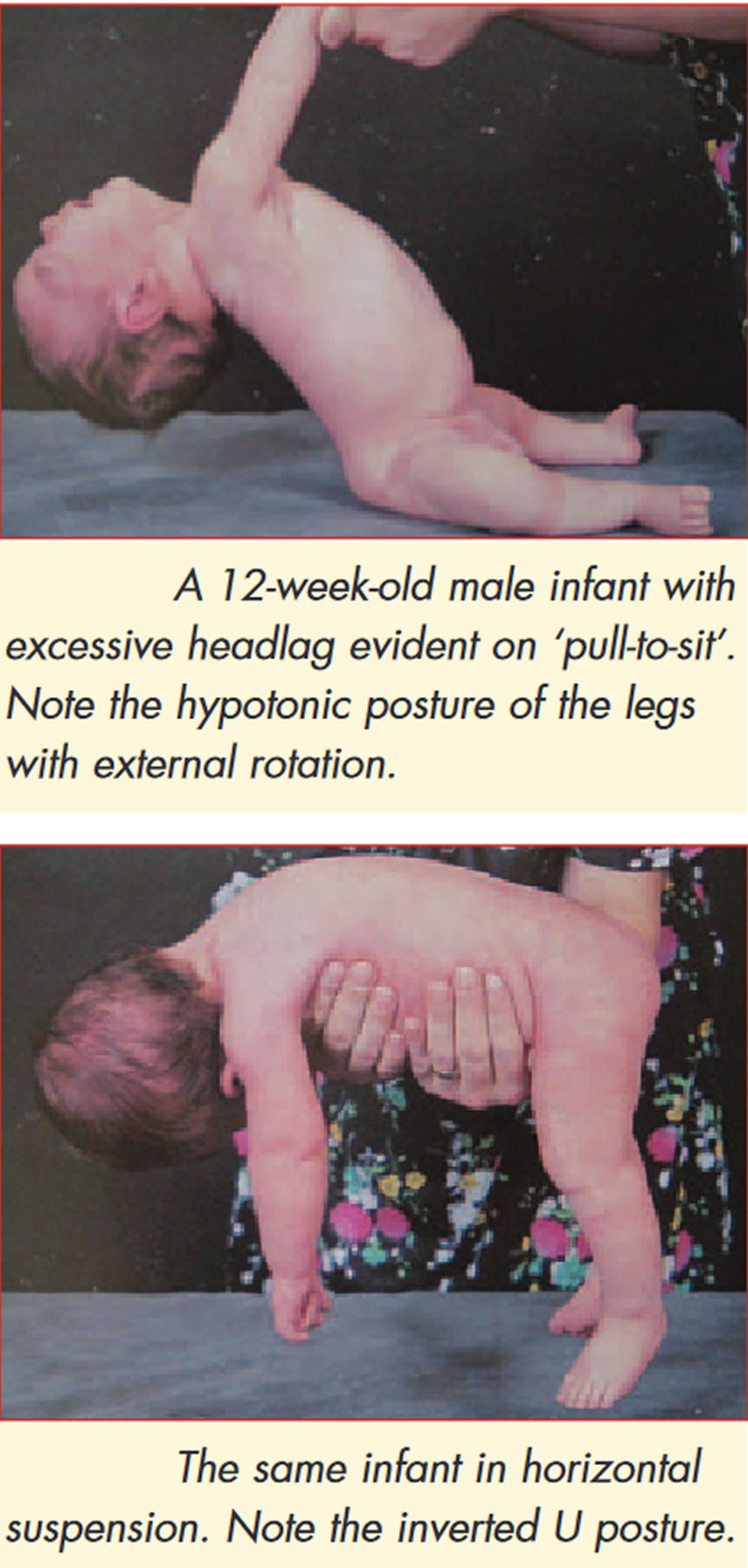 Floppy infant syndrome