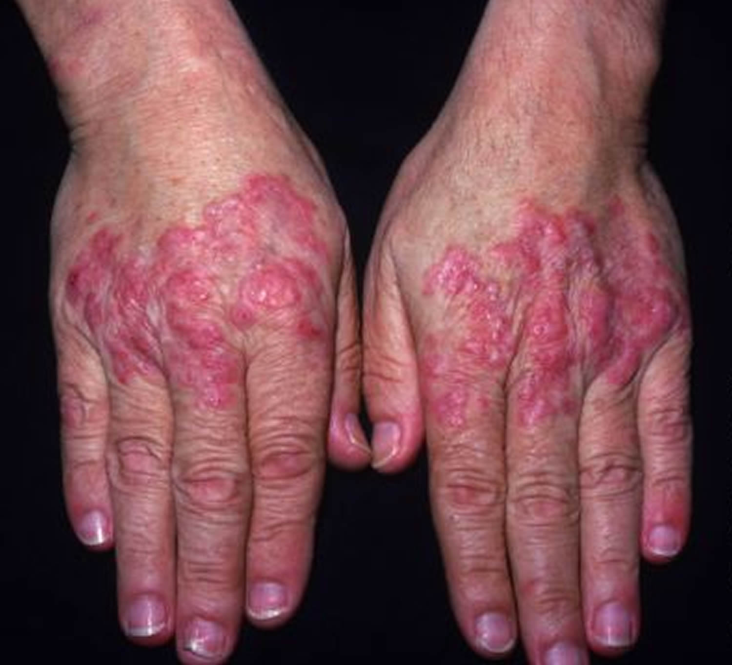 Systemic lupus erythematosus rash hand