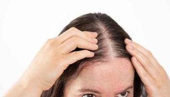 thinning hair women