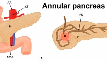 Annular pancreas