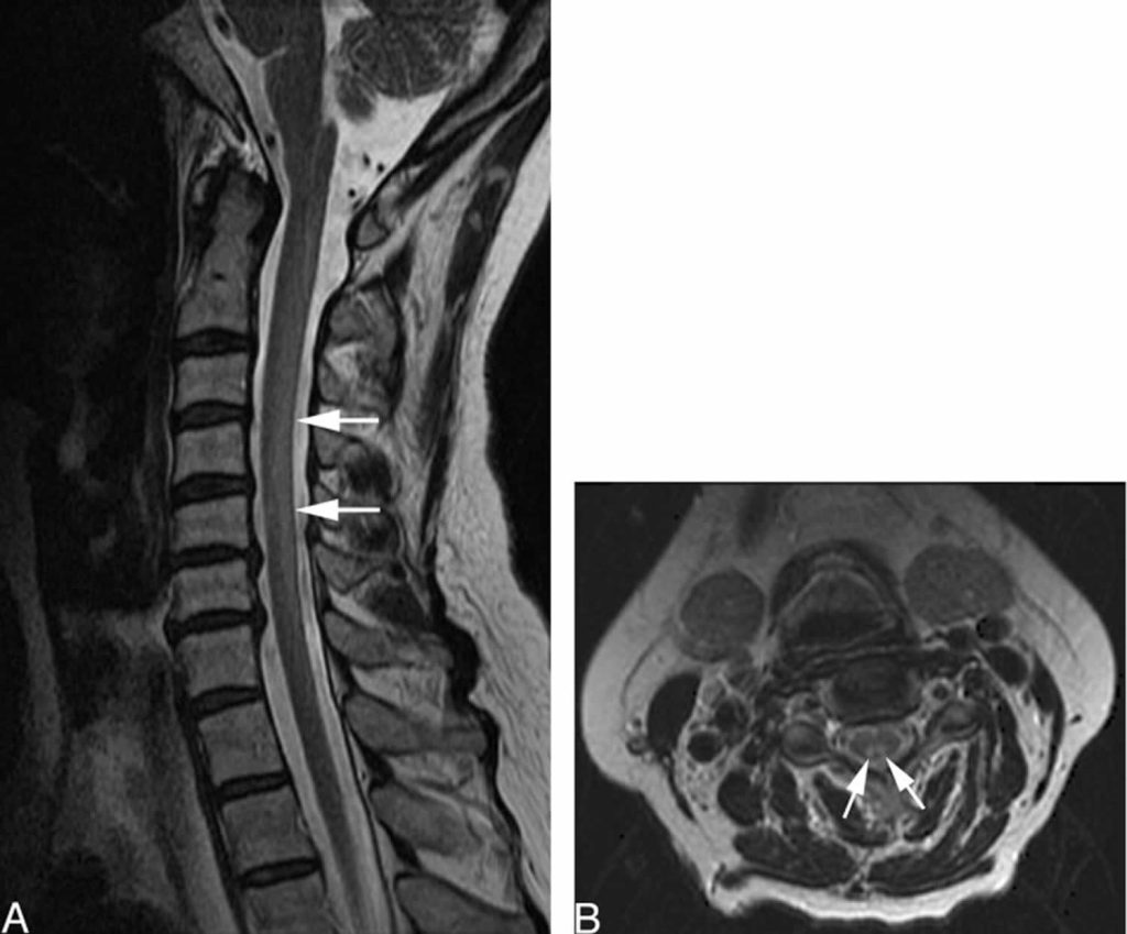 Myeloneuropathy causes, symptoms, diagnosis, treatment & prognosis