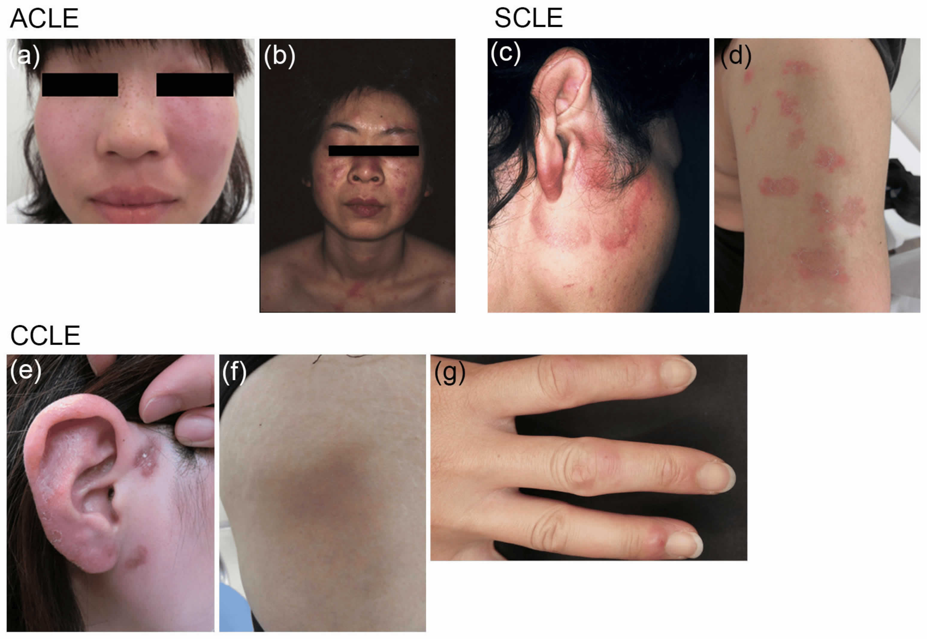 Cutaneous lupus erythematosus types