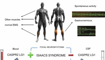 Isaacs syndrome