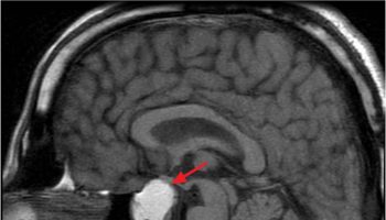 Pituitary apoplexy