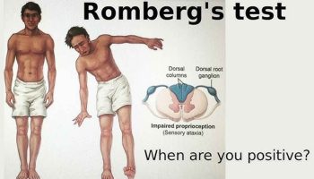 Romberg test