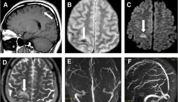 cortical vein thrombosis