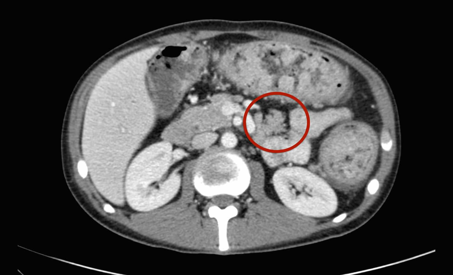 ectopic pancreatic tissue CT