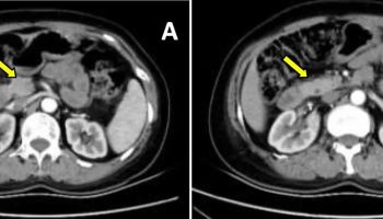 Agenesis of the dorsal pancreas