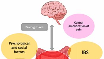 Chronic abdominal pain