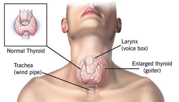 Thyrotoxicosis