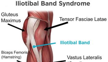 iliotibial band syndrome