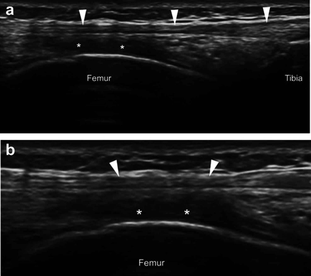 Iliotibial band syndrome, causes, symptoms, diagnosis, treatment ...