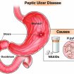 peptic ulcer disease