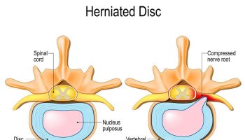 slipped disc