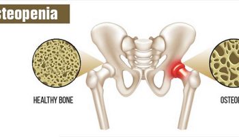 Osteopenia